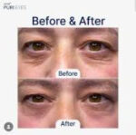 Puri Eyes 2% PN - Image 4